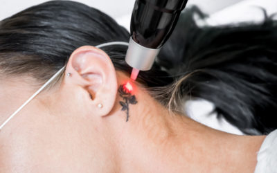 How to Choose the Best Cosmetic Tattoo Removal Method: Expert Guide to Laser and Non-Laser Options