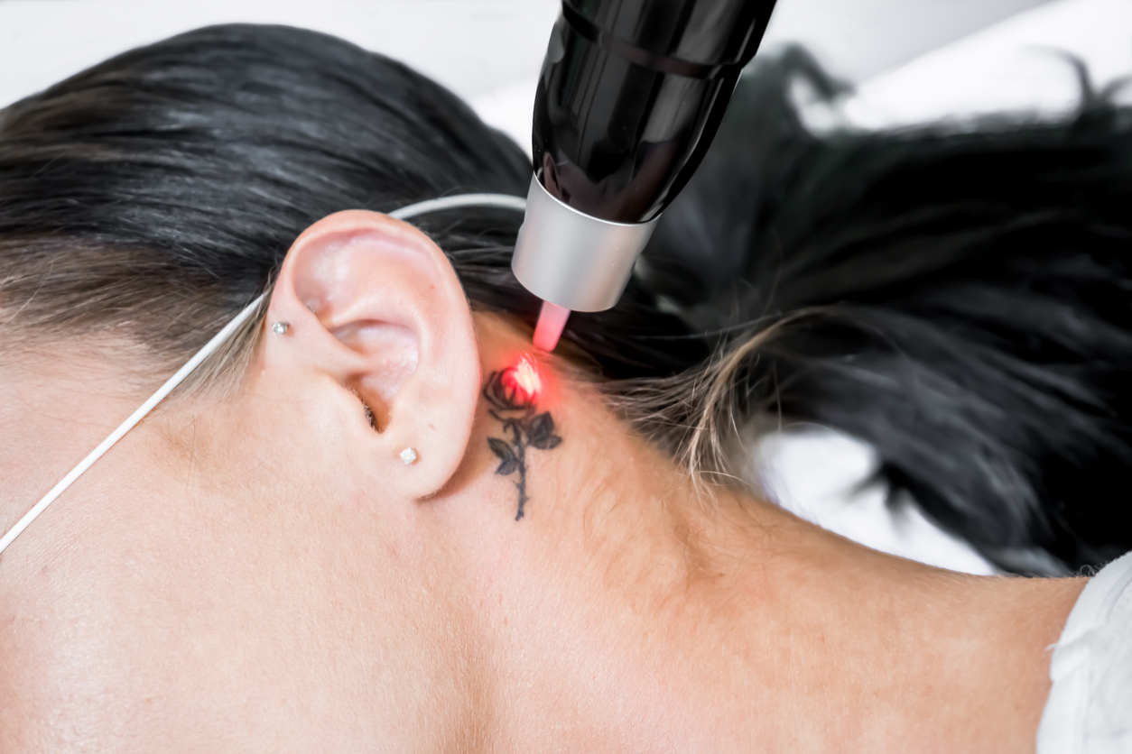 How to Choose the Best Cosmetic Tattoo Removal Met